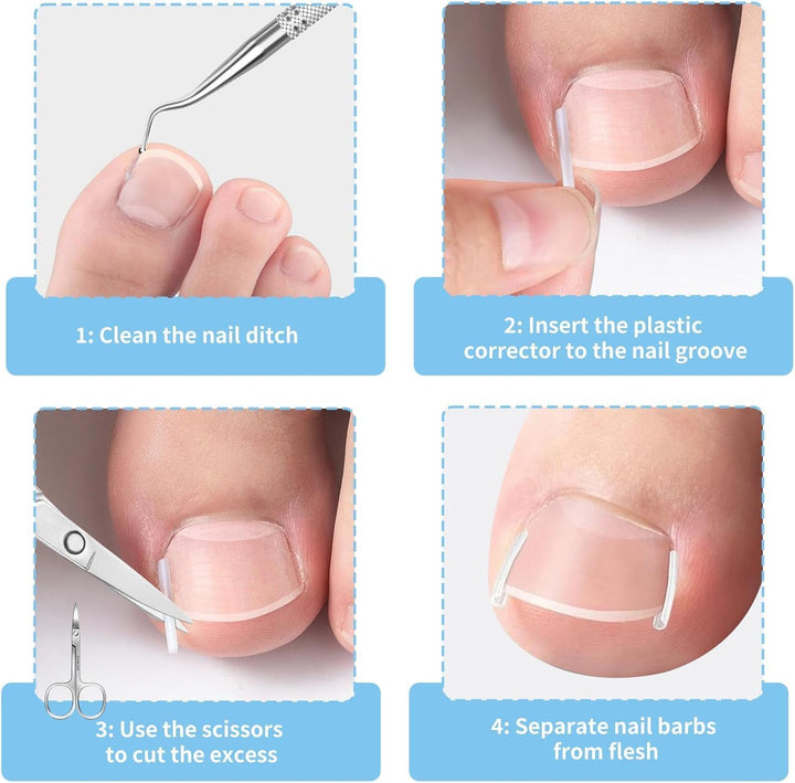 Ingrown Toenail Set - 60 Pcs Pain-Free Straightener Strips -Toe Lifter and Small Scissors- Easy Use Ingrown Toenail Set(Sliver)