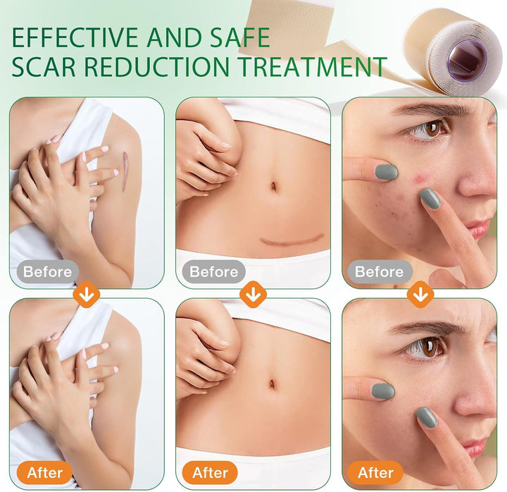 Silicone Scar Tape, Medical Grade Silicone Scar Sheets (1.6" X 75"-1.9M), Professional Scar Removal Treatment, Reusable Scar Tape for Healing Keloids, Surgeries Scars, C-Sections and Burns