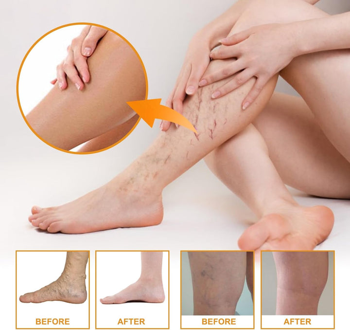 Varic/Ose Ve/Ins Treatment for Legs,Natural Varic/Ose Ve/Ins Cream,Varic/Ose Ve/Ins Treatment Cream,Cream for Varic/Ose Ve/Ins in Legs,Spi/Der V/Eins Repair Cream,Varic/Ose Ve/Ins Relief Cream