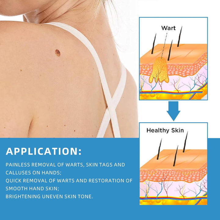 Wart Remover Cream for Body and Hands, Suitable for Common Warts, Flat Warts - 20G (1)