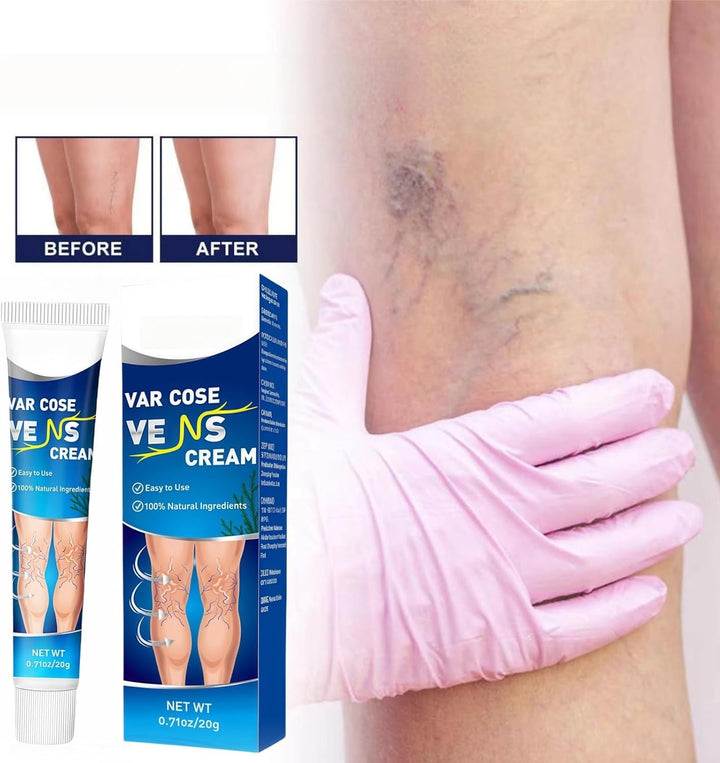 Varicos/E Ve/Ins Treatment for Legs,Varic/Ose Ve/Ins Treatment Cream,Sp/Ider Ve/Ins Repair Cream,Varicos/E Vein/S Cream,Spi/Der Vei/N Removal,Cre/Am for Varic/Ose V/Eins,Safe Formula,Portable