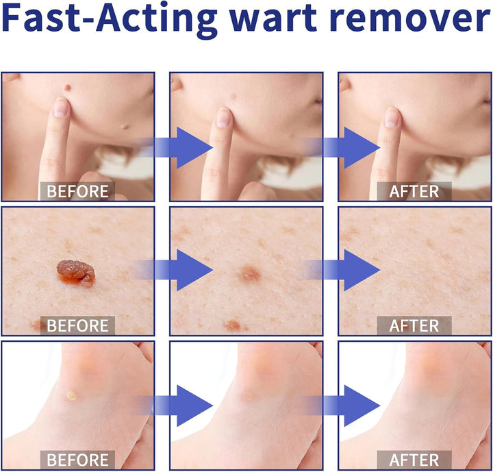 3Pcs Skin Tag Removal Kit, Wart Removal Pen 4ML, Effectively Targets Skin Tags, Mole, Calluses on Body (3)