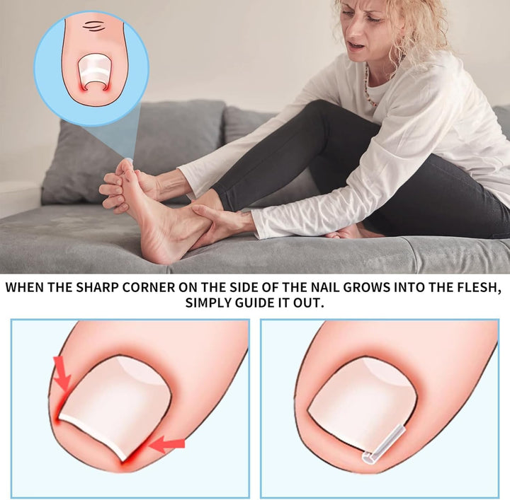 Ingrown Toenail Set - 60 Pcs Pain-Free Straightener Strips -Toe Lifter and Small Scissors- Easy Use Ingrown Toenail Set(Sliver)