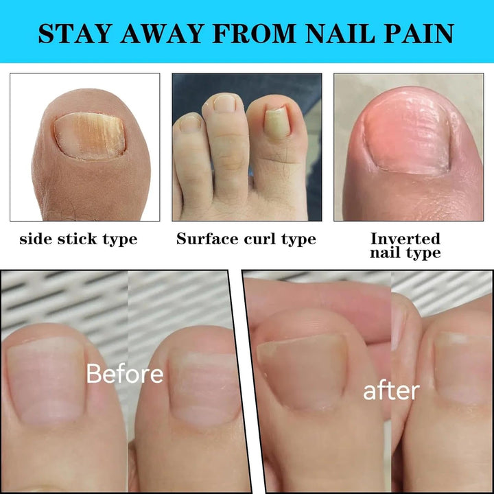 (50+1) Pcs Ingrown Toenail Tool Kit - Corrector with Lifter & Straightener Strips, Pain-Free Treatment for In-Grown Toe Nails, Easy Fixed Toenail Correction Tool.