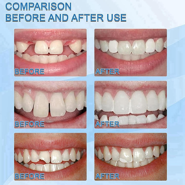 Temporary Tooth Filling,Repair Beads Tooth Repair Kit,Moldable False Teeth,Tooth Filling Repair Kit,Filling Kit for Teeth,Diy Tooth Repair Granules,Dental Repair Kit Filling,Broken Tooth Repair