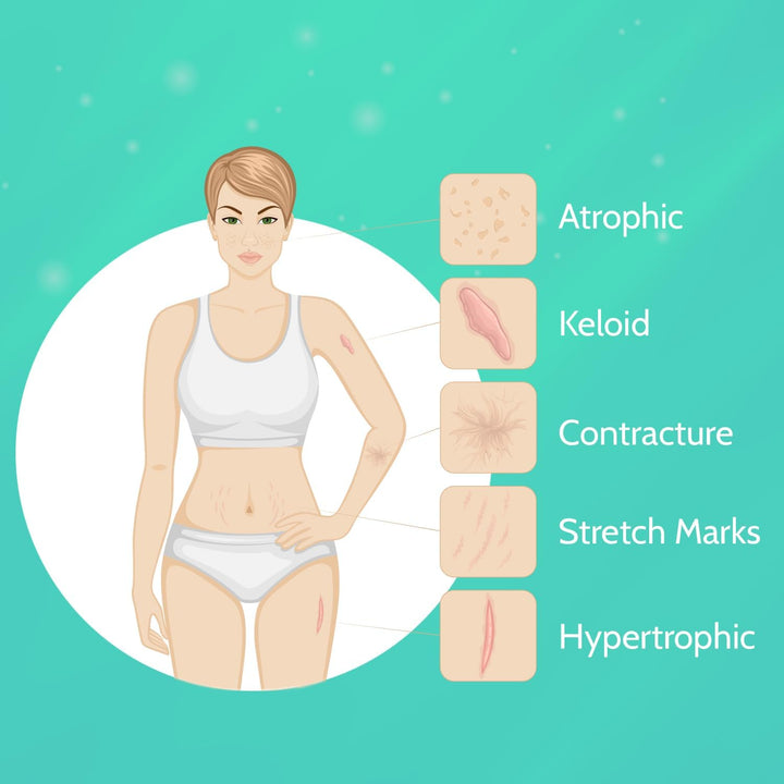 Silicone Scar Gel Removal Cream: Scar Treatment for Burns, Surgery, and Stretch Marks – Suitable for Old and New Scars – Improves Appearance on Face and Body, 30G