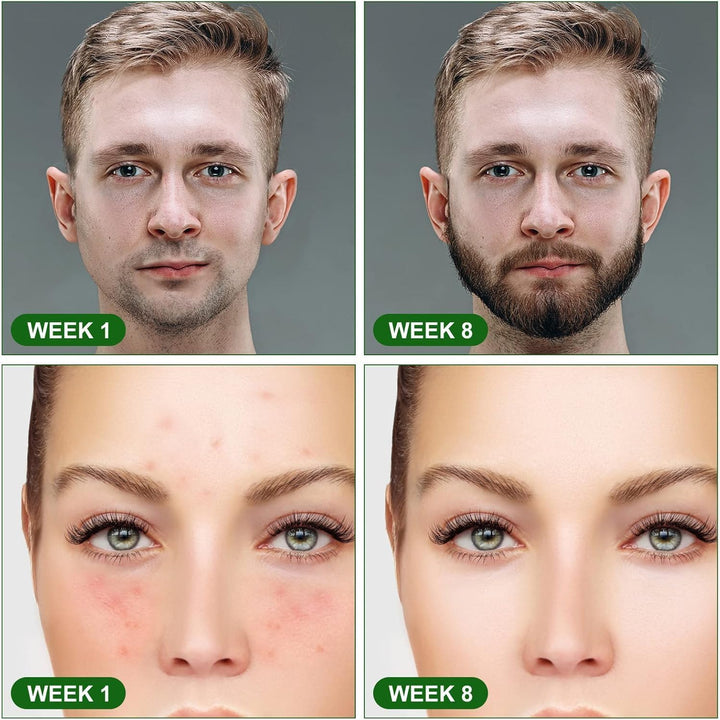 Derma Roller for Hair Growth| Microneedling Roller for Face Body Scalp| Derma Roller for Men & Women| Micro Needling Roller 540 Titanium Needle Home Use, Acne Marks, Cellulite Treatmment (0.5Mm)