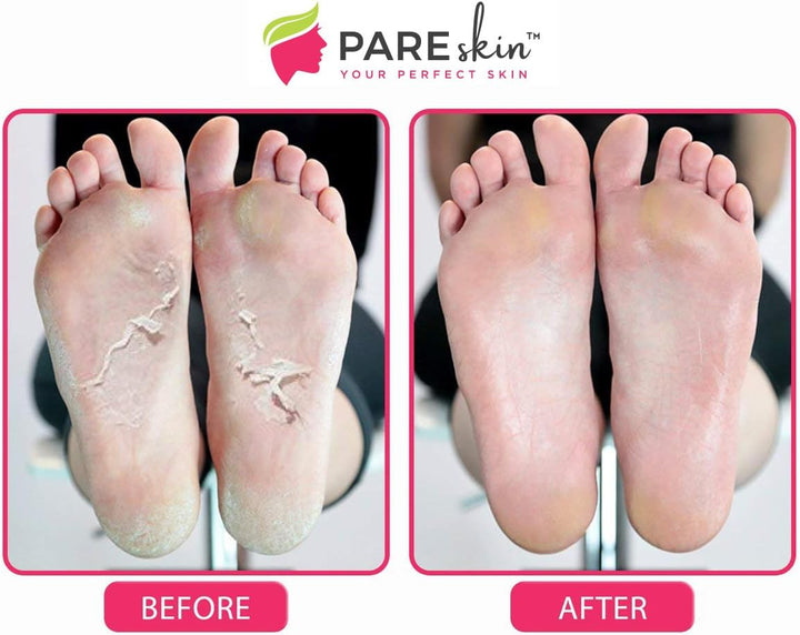 [ 2 Pack ] Foot Peel Mask - Cracked Heels Repair for Dry Callus Dead Skin - Exfoliating Peel Remover for Baby Soft Feet