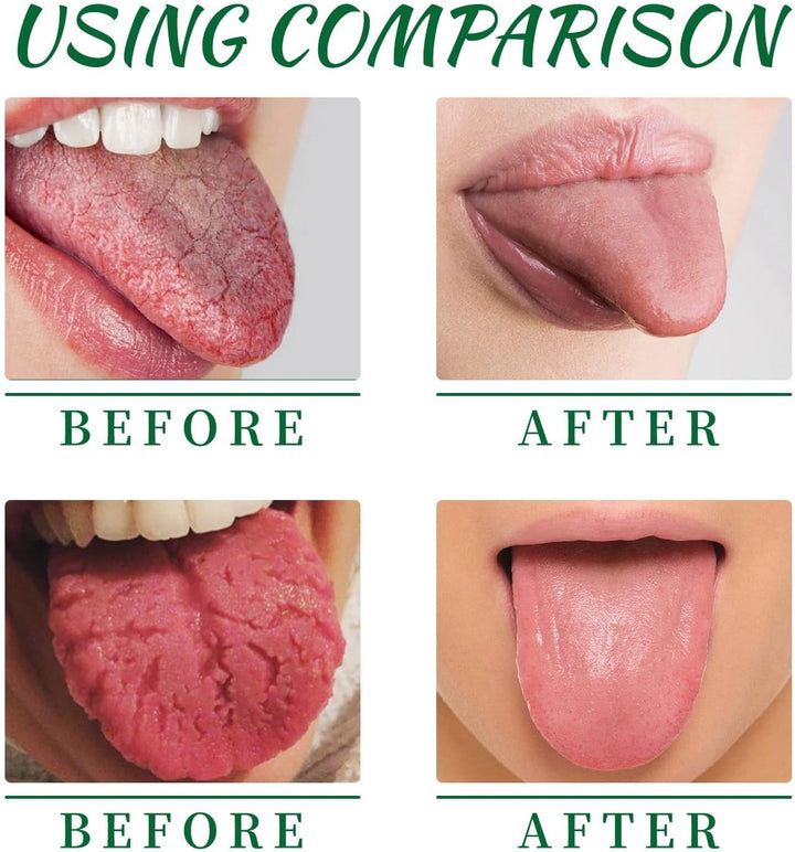 Tongue Repair Spray,Moisturizing Dry Mouth Spray,Fissured Tongue Relief Spray,Instant Dry Mouth Relief,Breath Freshener Spray for Tongue Relief,Tongue Relief Treatment,For White Coating/Bad Breath