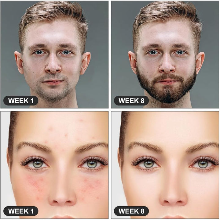 Derma Roller, 1Mm Microneedle Derma Roller for Men and Women, Professional Microneedling Derma Needling, Micro Needle Roller Facial Wrinkles Hair Loss Stretch Marks Hair Regrowth