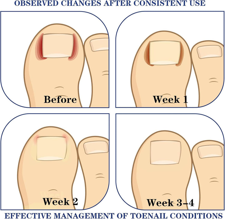 60Pcs Ingrown Toenail Treatment Patches, Toe Nail Correction Patches, Painless Hammer Toe Corrector, Durable Toe Spacers, Quick Repair Ingrown Nail Tool for Women Men