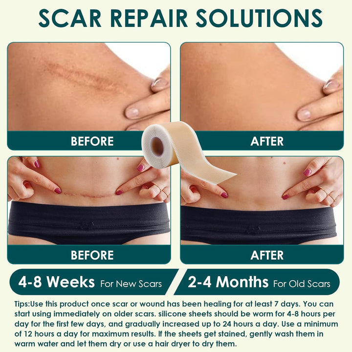 Silicone Scar Sheets, Premium Silicone Gel Scar Tape, Reusable Silicone Patches, Painless Silicone Tape Roll, Silicone Scar Tape for Surgeries Scars, C-Sections, 1.6'' X 120''Roll-3M