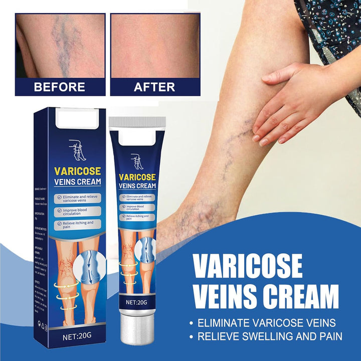 Leg Varicose Ointment,Varicose Vein Gel,Varicose Vein Removal Cream,Vein Relief Cream for Pain Relief, Natural Varicose,20G