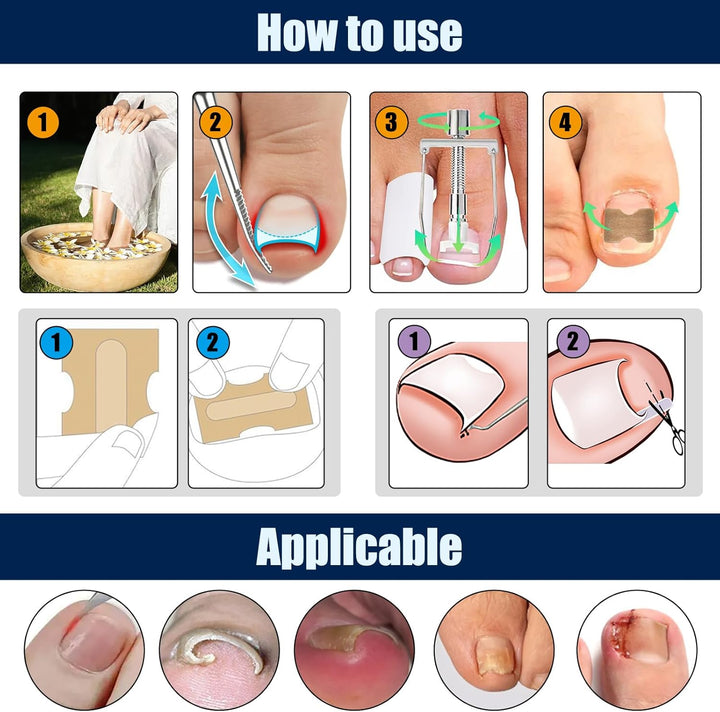 Ingrown Toenail Removal Kit Ingrown Toenail Treatment Tool Kit Ingrown Toenail Corrector Tools with Toenail Braces, Podiatry Tools, Ingrown Toenail Corrector Strips and Patch for Toe Pain Relief