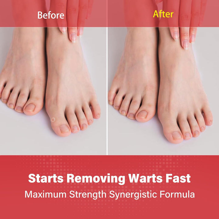Fast Acting Wart Remover, Verruca Remover, Gentle Removal of Common Warts, Plantar Warts, Corn and Calluse, Suitable for Hands and Feet, Trusted by the Whole Family