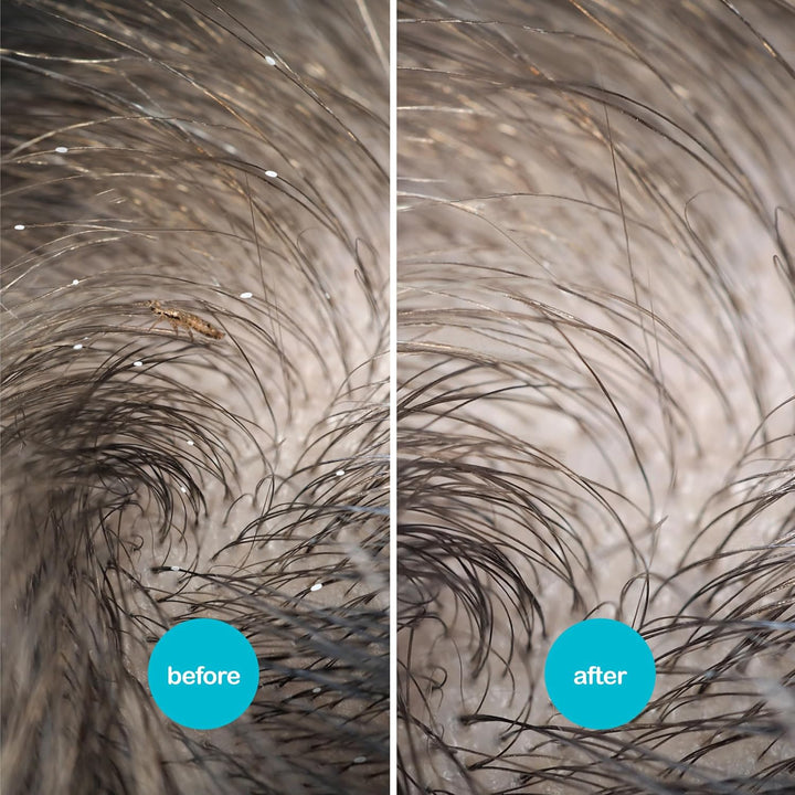 All-In-One Head Lice Treatment Spray, Kills Nits & Eggs, Includes Lice Spray 120Ml & Nit Comb ,120 Ml (Pack of 1)