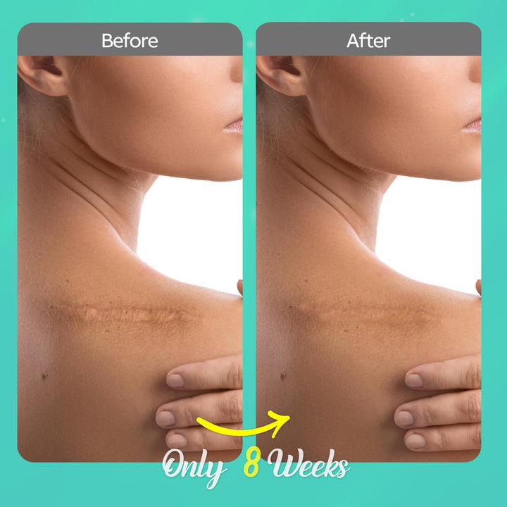 Silicone Scar Gel Removal Cream: Scar Treatment for Burns, Surgery, and Stretch Marks – Suitable for Old and New Scars – Improves Appearance on Face and Body, 30G