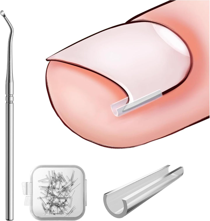 Ingrown Toenail Corrector Set - 40 Pcs Pain-Free Toenail Straightener Strips with Toenail Lifter - Easy Use Ingrown Toenail Tools Kit