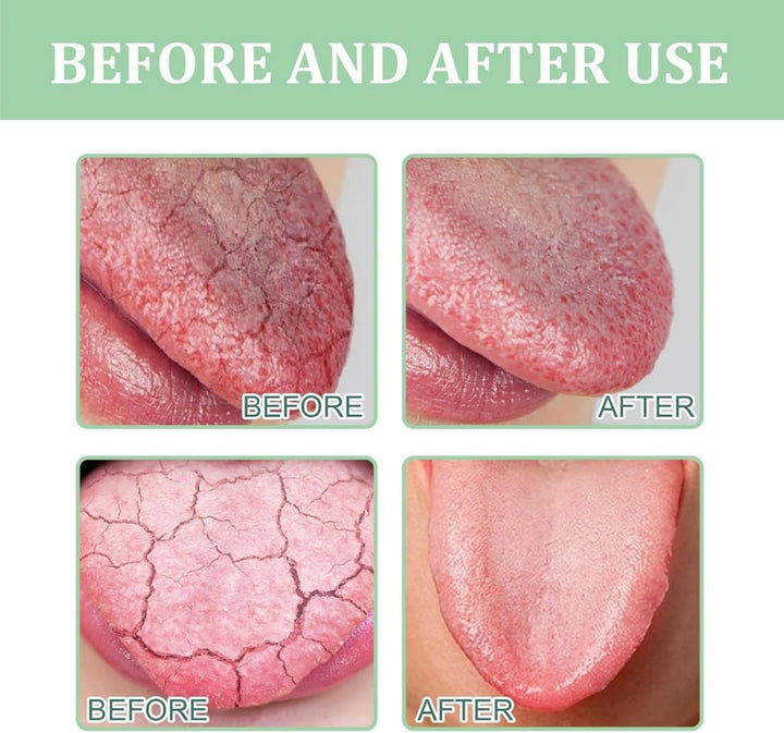 Tongue Repair Spray,So/Re Tongue Relief,Breath Freshener Spray,So/Re Mouth and Ton-Gue Treatment,Remove White Dirt,Instant Dry Mouth Relief,Moisturizing,Natural Ingredients,Mild and Non-Irritating
