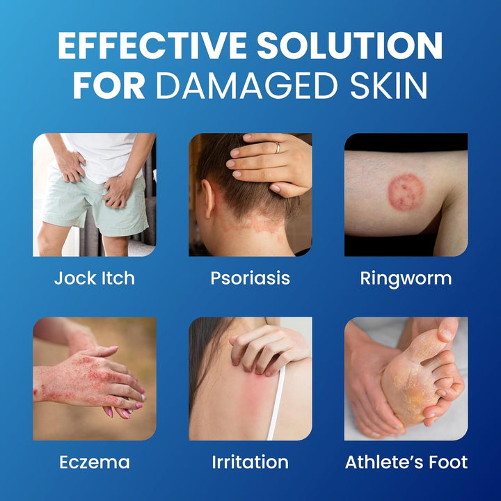 Jock Itch, Psoriasis & Ringworm Cream | Itch Relief | Reduce Scaling | Soothe Irritation | Hydrating Skin Care | 150Ml