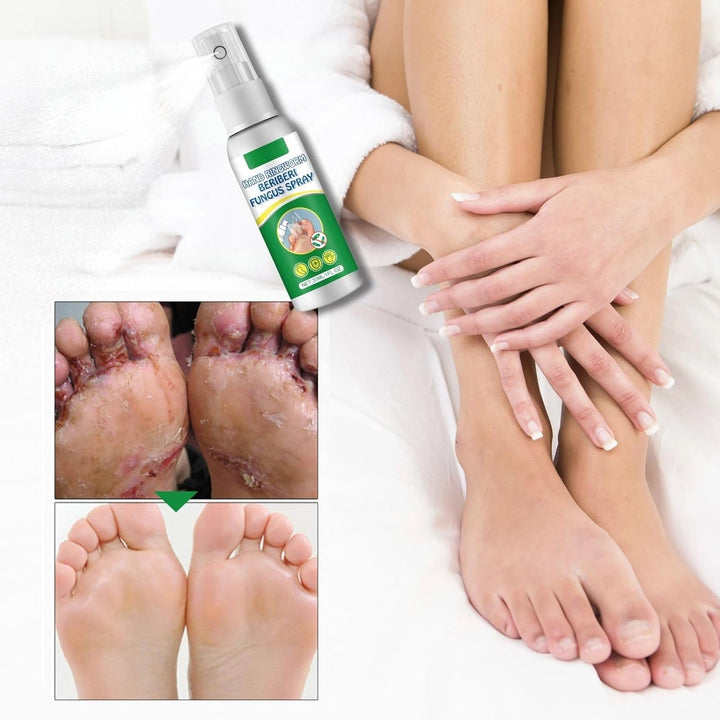 1Pcs Athlete'S Foot Spray 30Ml - Fast-Acting anti Fungal Spray for Foot Fungus Treatment, Feet Deodorant for Smelly Feet, Athlete'Sfoot Treatment with Natural Ingredients and Moisturising
