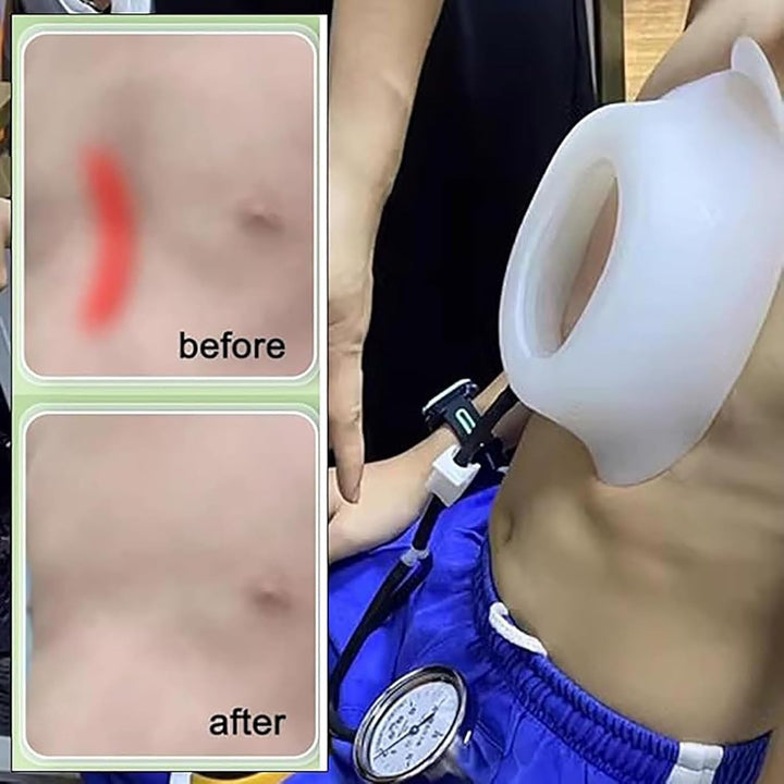 Pectus Excavatum Corrector,Pectus Excavatum Vacuum Bell for Adults and Child,Physical Correction,Washable,With Pressure Gauge,L