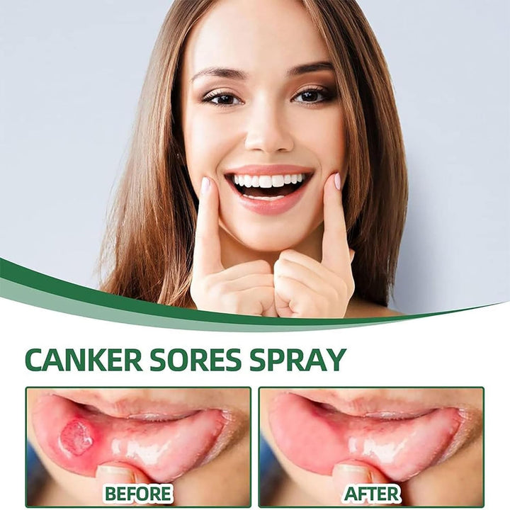 Mouth Ulcer Treatment Spray,Mouth Ulcer Treatment for Adults,Canker Sore Relief Treatment,Herbal Mouths Sprays for Ulcer Treatments,Dry Mouth Relief,Breath Freshener Spray(Pack of 1)