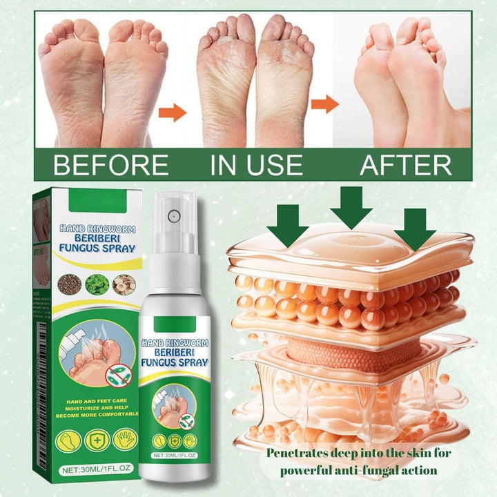 1Pcs Athlete'S Foot Spray 30Ml - Fast-Acting anti Fungal Spray for Foot Fungus Treatment, Feet Deodorant for Smelly Feet, Athlete'Sfoot Treatment with Natural Ingredients and Moisturising
