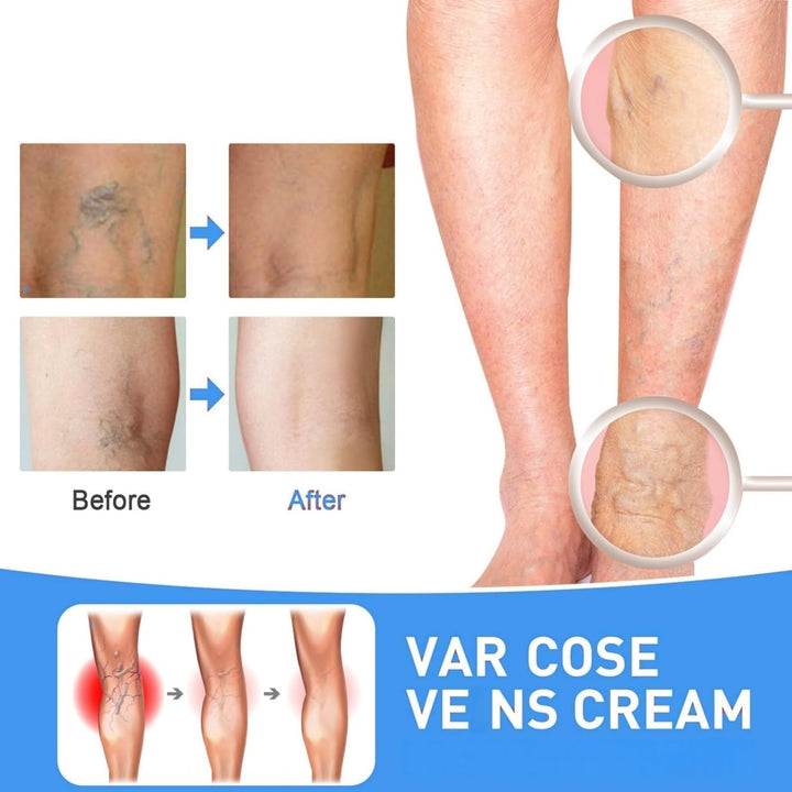 Varicos/E Ve/Ins Treatment for Legs,Varic/Ose Ve/Ins Treatment Cream,Sp/Ider Ve/Ins Repair Cream,Varicos/E Vein/S Cream,Spi/Der Vei/N Removal,Cre/Am for Varic/Ose V/Eins,Safe Formula,Portable