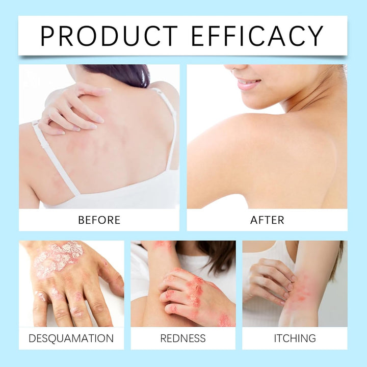 Antifungal Cream - anti Fungal Skin Cream - Ringworm, Jock Itch, Eczema, Tinea Versicolor, Athletes Foot Treatment - Fast Acting & Gentle Safe & Soothing Hydrating Formula