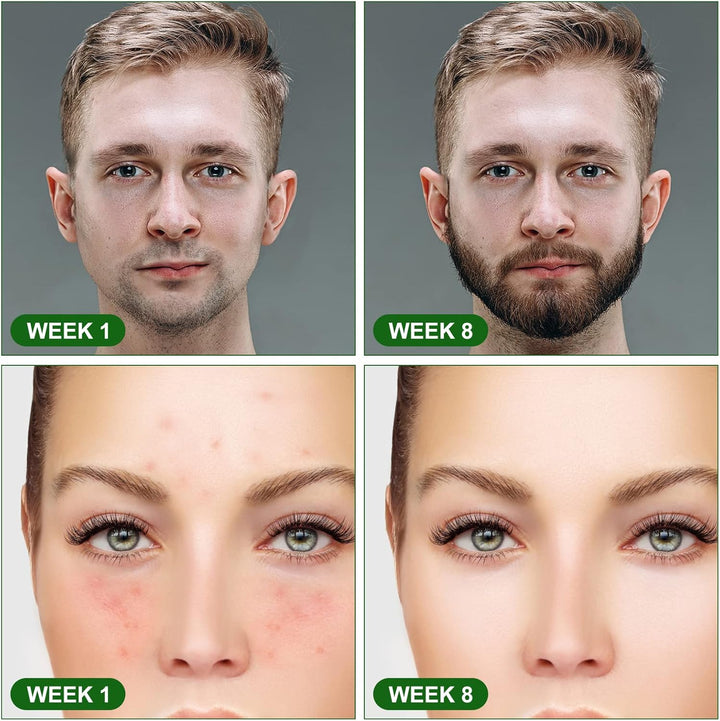 Derma Roller, 0.5Mm Beard Roller, 540 Titanium Micro Needling Rollers for Men and Women, Beard Growth Rollers for Stimulate Hair Growth, Facial Skin Care, Scar Removal