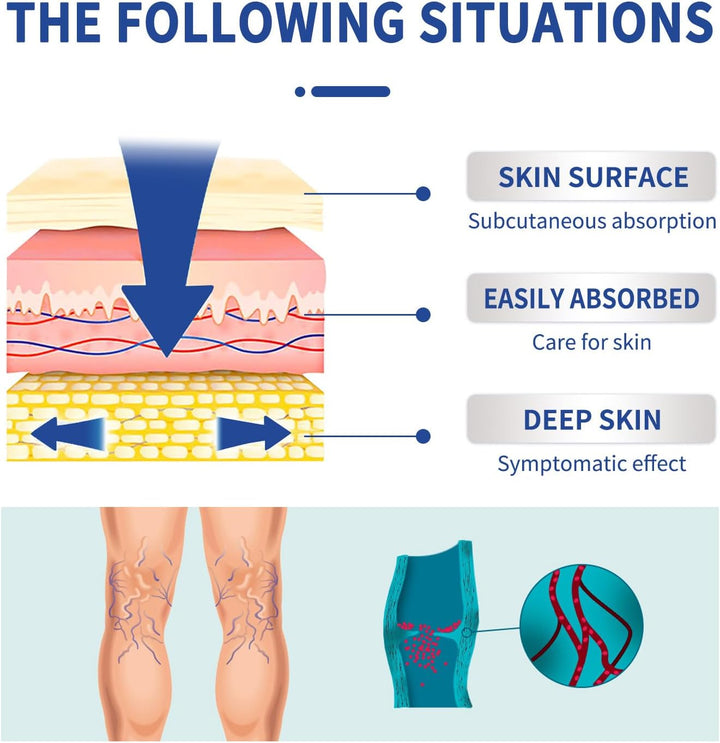 Leg Varicose Ointment,Varicose Vein Gel,Varicose Vein Removal Cream,Vein Relief Cream for Pain Relief, Natural Varicose,20G