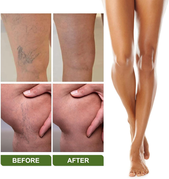 Varic/Ose Ve/Ins Treatment for Legs,Natural Varic/Ose Ve/Ins Cream,Varic/Ose Ve/Ins Treatment Cream,Cream for Varic/Ose Ve/Ins in Legs,Spi/Der V/Eins Repair Cream,Varic/Ose Ve/Ins Relief Cream