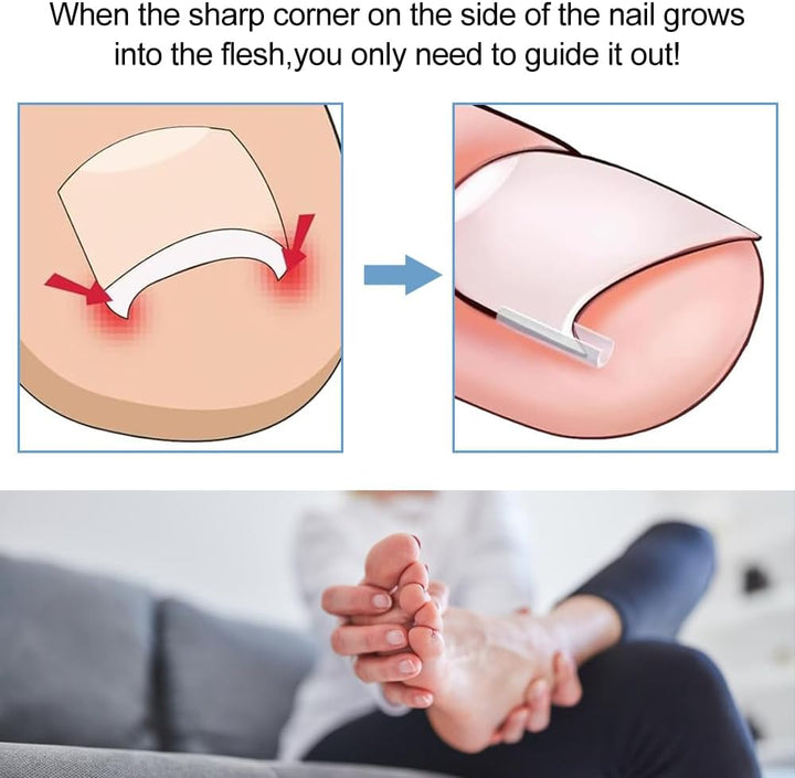 Ingrown Toenail Corrector Set - 50 PCS Pain-Free Toenail Straightener Strips with Toenail Lifter - Easy Use Ingrown Toenail Tools Kit