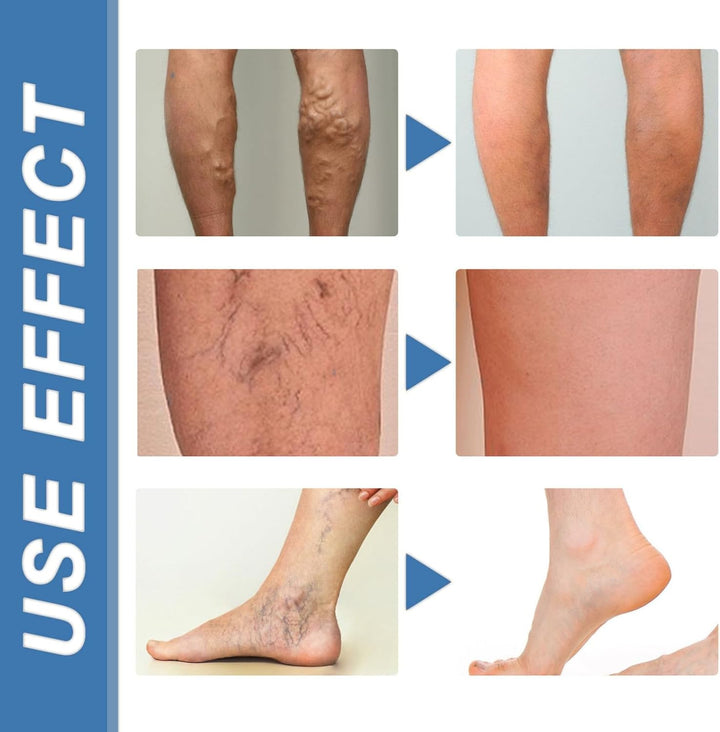 Varicos/E Ve/Ins Treatment for Legs,Varic/Ose Ve/Ins Treatment Cream,Sp/Ider Ve/Ins Repair Cream,Varicos/E Vein/S Cream,Spi/Der Vei/N Removal,Cre/Am for Varic/Ose V/Eins,Safe Formula,Portable