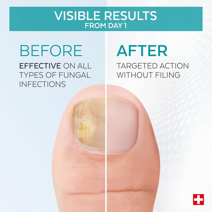 - FUNGAL NAIL TREATMENT - Nail Fungus Treatment for Toenail - Exceptional and Powerful Plants Anti-Fungal Restorative Properties - Professional Foot/Hand Treatment - Quick&Easy - Swiss Made