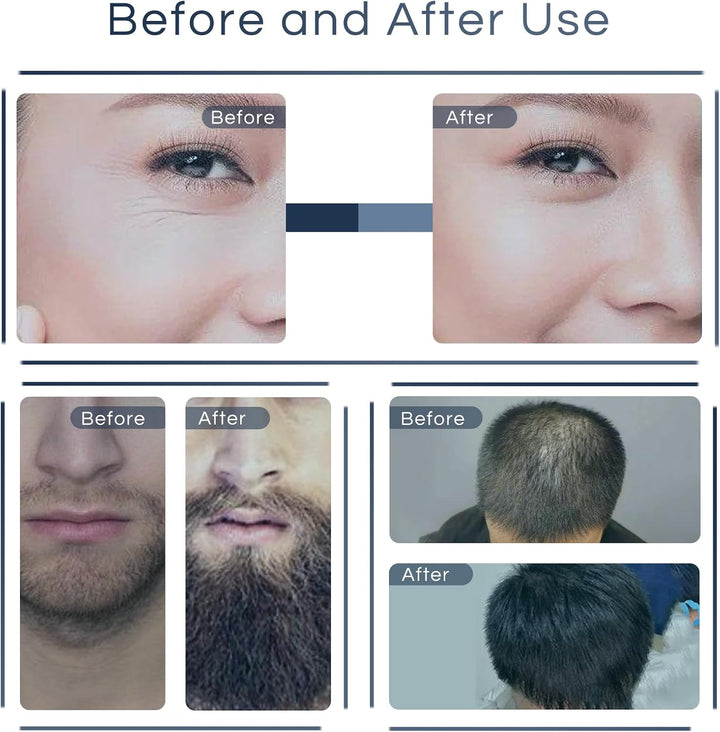 Adjustable Derma Stamp, 0-3Mm 140 Titanium Pins Professional Microneedle Dermastamp for Hair Beard Growth Face Body, Derma Roller Microneedling Pen Alternative