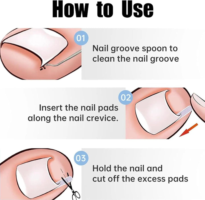 (50+1) Pcs Ingrown Toenail Tool Kit - Corrector with Lifter & Straightener Strips, Pain-Free Treatment for In-Grown Toe Nails, Easy Fixed Toenail Correction Tool.