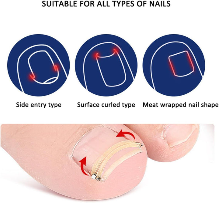 Ingrown Toenail Corrector, Stainless Steel Curved Toenail Straightener with Rubber Bands, Ingrown Toenail Removal Kit, Professional Ingrown Toenail Pedicure Tools for Men Women Curved Nail Repair