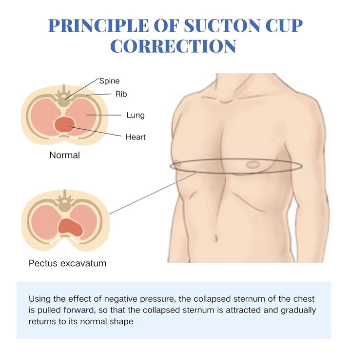 Pectus Excavatum Orthosis Brace, Pectus Excavatum Vacuum Bell with Pressure Gauge, Sternal Depression Support for Sunken Chest, Physical Chest Correction for All Ages (L)