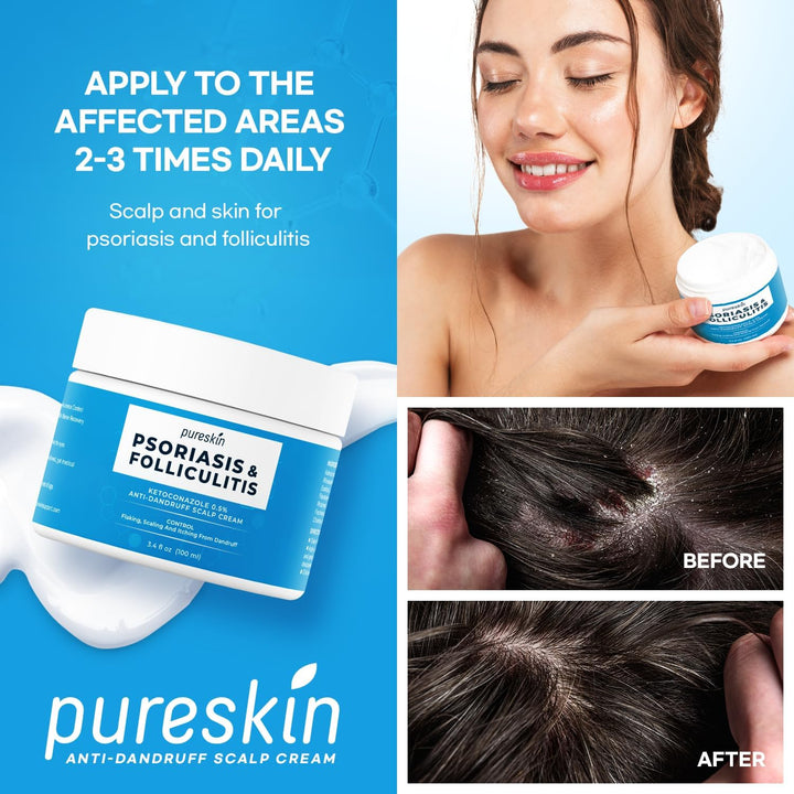 Psoriasis Scalp Treatment Cream - Extra Strength for Scalp Psoriasis Folliculitis - Controls Itching Flaking Stubborn Dandruff 3.4 Oz