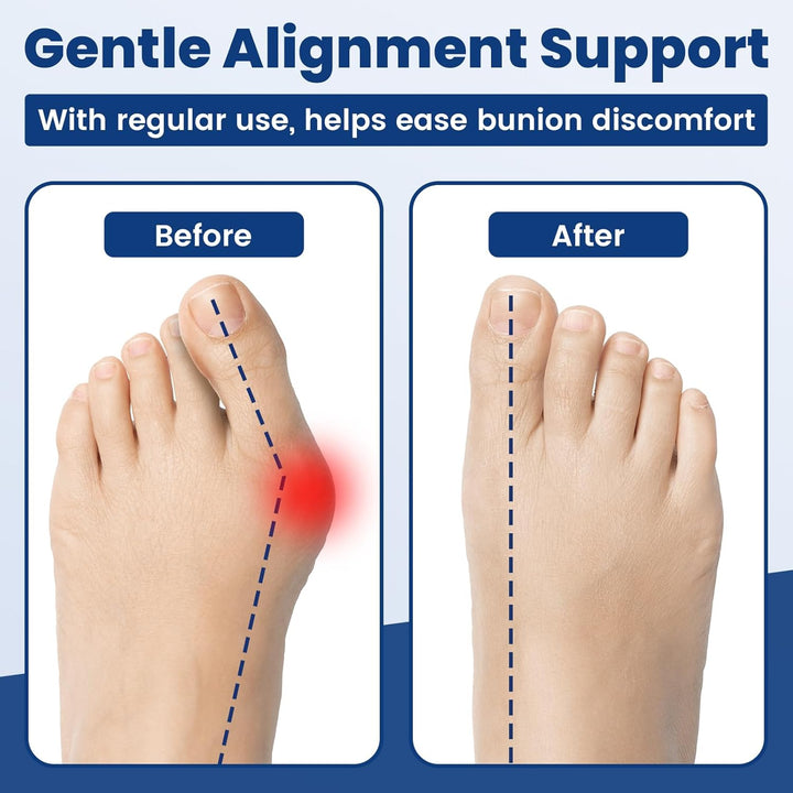 Hallux Valgus Training Bands (3 Pack), Toe Straightener for Bunion Correction & Pain Relief, Toe Stretch Band for Alignment & Flexibility Training