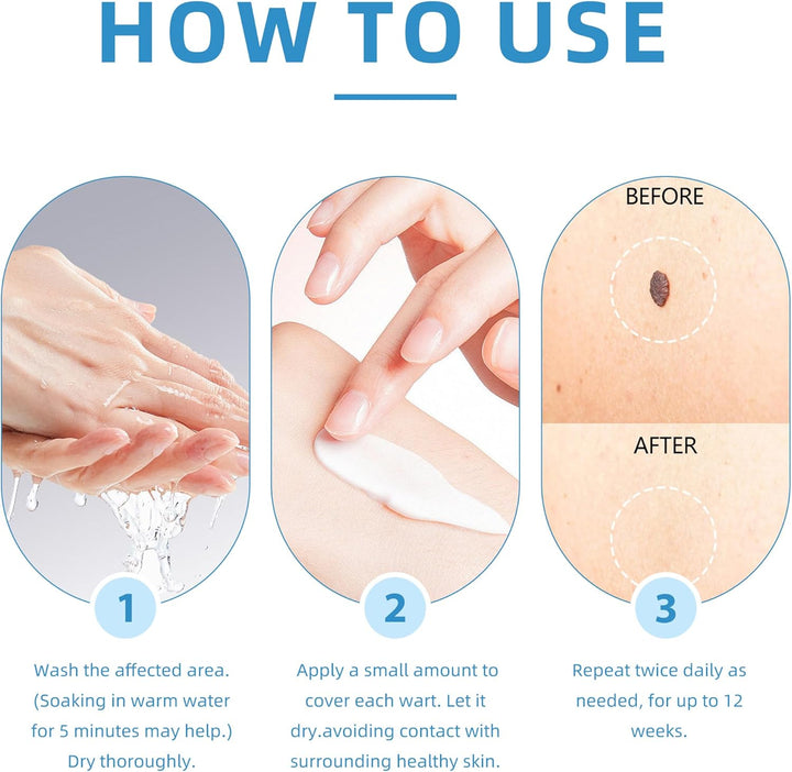 Wart Remover Cream for Body and Hands, Suitable for Common Warts, Flat Warts - 20G (1)