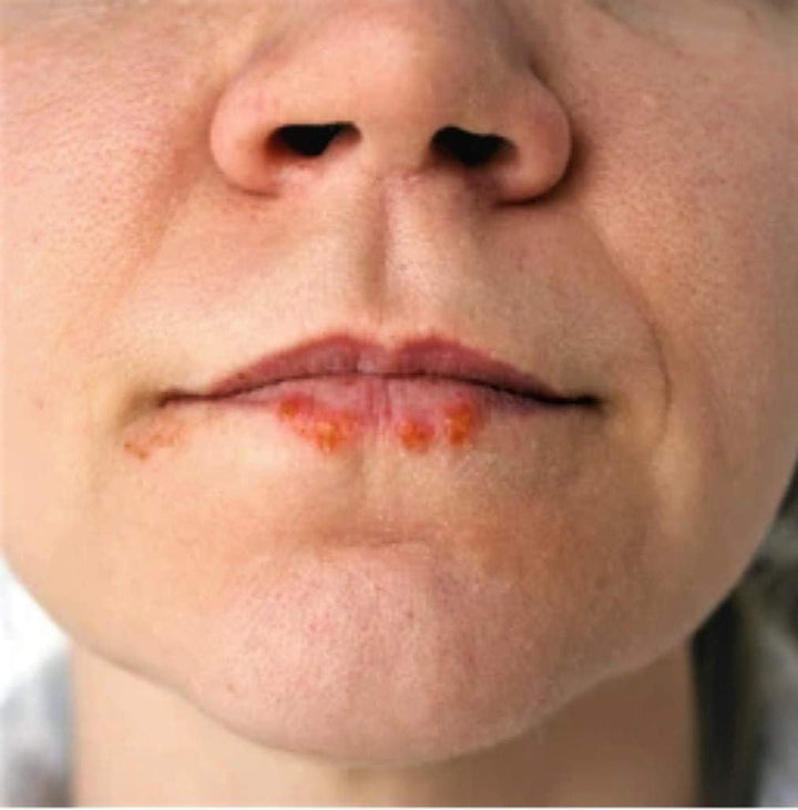 Tea Tree Ointment for Dry Skin, Handmade, Natural Beeswax, Tea Tree Balm, Vitamin E, Sweet Almond Oil, Salve for Cuts, Burns, Insect Bites, Soothing Skin Moisturiser with Sunflower Oil (60Ml)