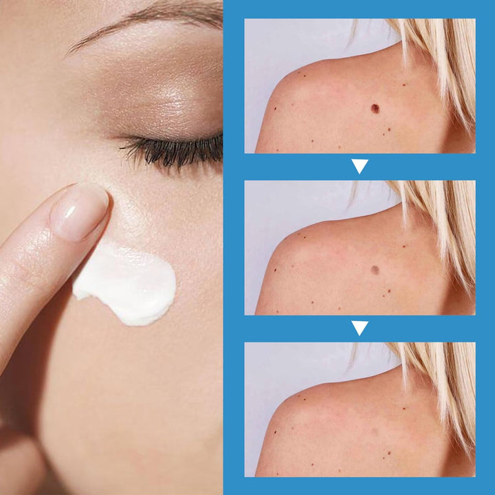 Wart Remover Cream for Body and Hands, Suitable for Common Warts, Flat Warts - 20G (1)