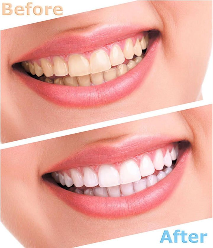 35% Whitening Gel Refills with LED Light and Mouth Trays - 10 PCS 3ML Teeth Gel - Oral Bleaching Treatment