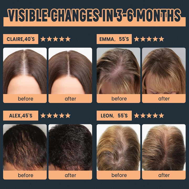 Laser Hair Growth Cap, 84 * 660Nm & 84 * 850Nm Wireless Infrared Red Light Therapy Beret Hat for Damaged Hair Repair, Prevent Hair Loss and Hair Regrowth Women and Men