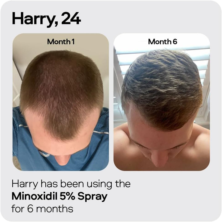 Minoxidil 5% Spray for Men (3X60Ml), Clinically Proven Hair Regrowth & Thickening Formula, Anti-Hair Loss Treatment, Stimulates Follicles, Easy to Use Precision Application System, Made in Europe