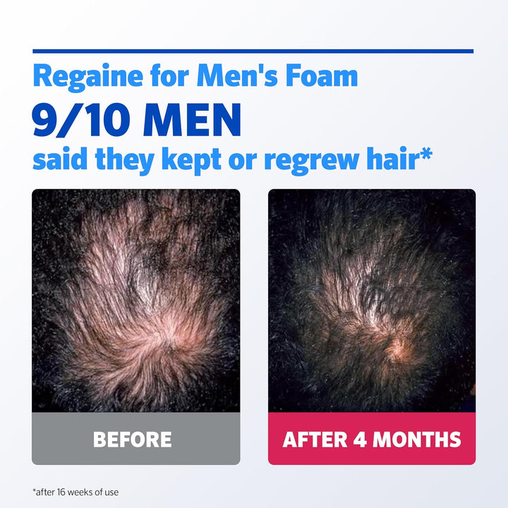 for Men Extra Strength Foam - Scientifically Proven to Help Stop Hereditary Hair Loss - Minoxidil Foam for Hair Regrowth - (3 X 73Ml), Packaging May Vary