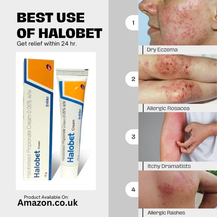 Propionate Cream 0.05% W/W - Fast Relief for Skin Irritation, Eczema, Dermatitis, Rashes, Itching, Hay-Fever Allergy, Insect Bites - Dermatologist Tested | Result within 24Hr.